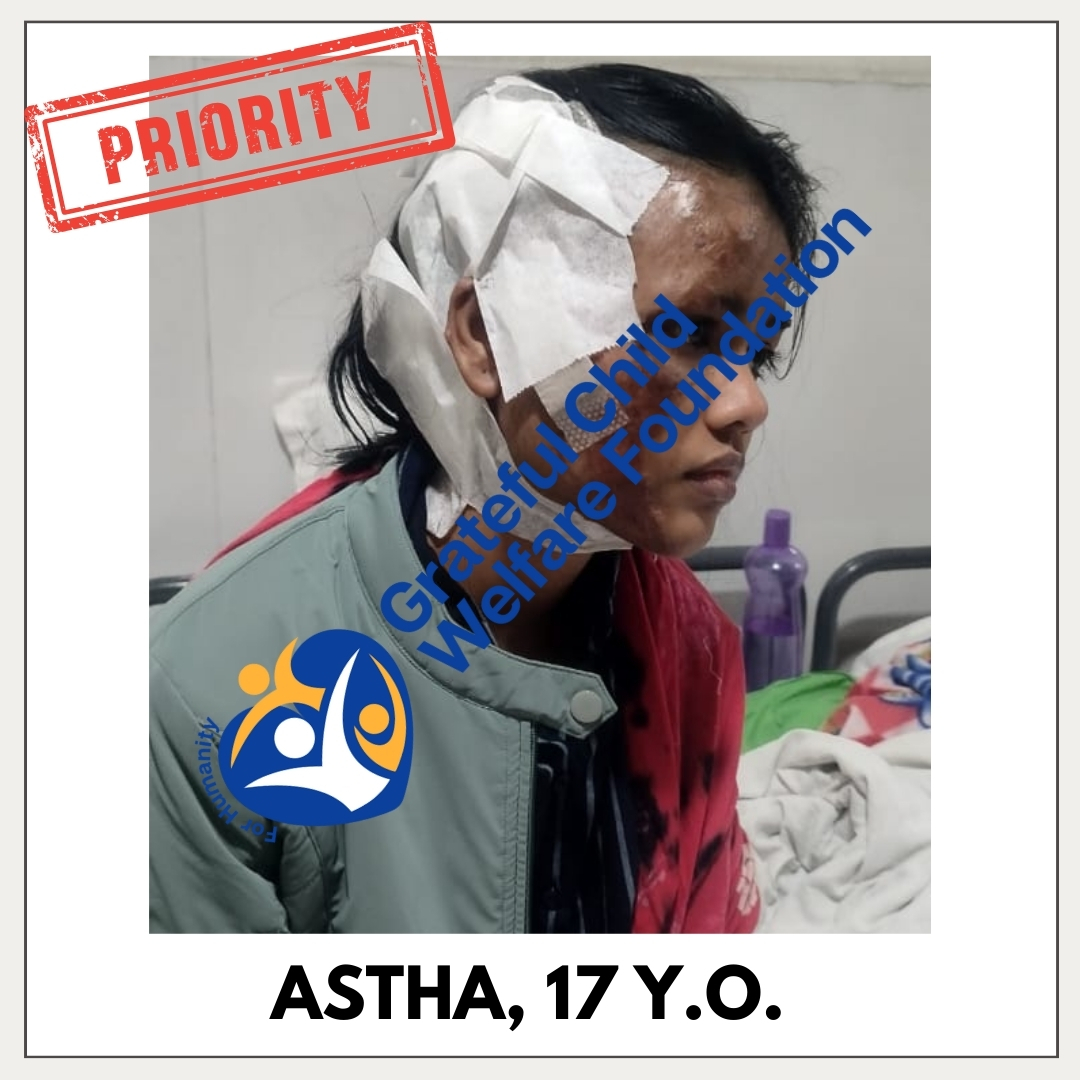 Astha Kumari - Face and Head Burn